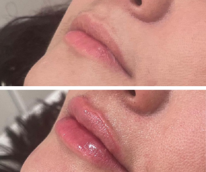 عکس تزریق نیم سی سی ژل لب