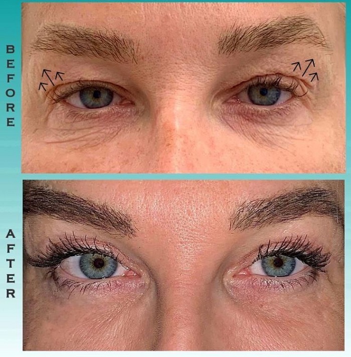 عکس قبل و بعد بلفاروپلاستی چشم گربهای عکس قبل و بعد بلفاروپلاستی چشم گربهای