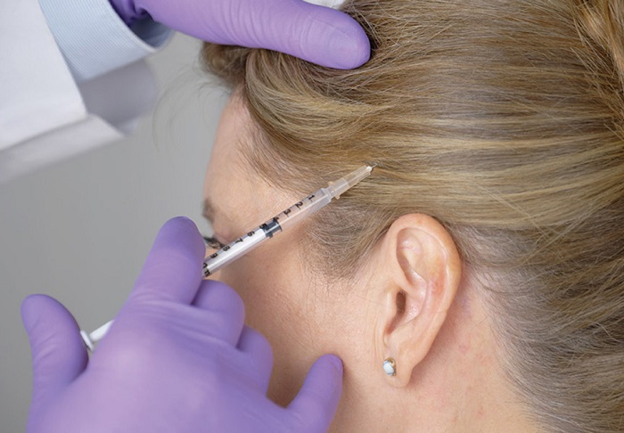 نحوه تزریق بوتاکس برای میگرن نحوه تزریق بوتاکس برای میگرن