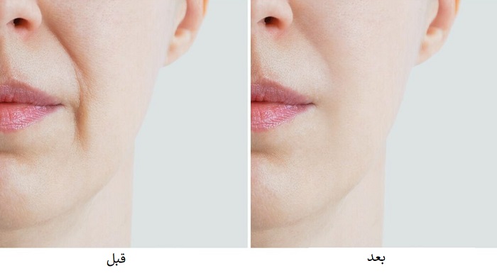 عکس قبل و بعد تزریق ژل خط خنده عکس قبل و بعد تزریق ژل خط خنده