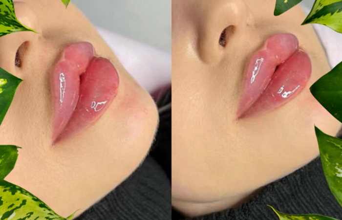 مزایای تزریق ژل لب چاکدار مزایای تزریق ژل لب چاکدار
